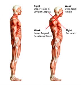 Upper crossed syndrome