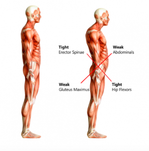 lower crossed syndrome