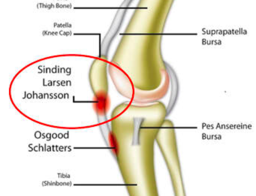 ADOLESCENT HEALTH: SINDING-LARSEN-JOHANSSON SYNDROME – PAIN UNDER THE KNEE CAP