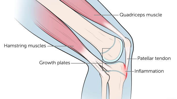 MY SPORTY CHILD HAS KNEE PAIN. WHAT'S GOING ON? 2 Screen Shot 2024 06 13 at 1.15.43 pm
