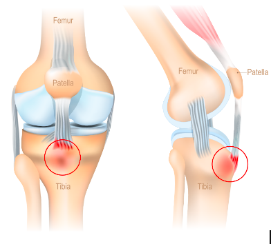 OSGOOD-SCHLATTER DISEASE VS SINDING-LARSEN-JOHANSSON SYNDROME 1 Screen Shot 2024 06 14 at 1.40.57 pm
