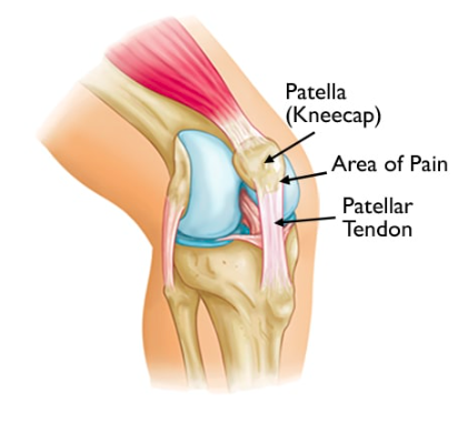 OSGOOD-SCHLATTER DISEASE VS SINDING-LARSEN-JOHANSSON SYNDROME 2 Screen Shot 2024 06 14 at 1.45.51 pm