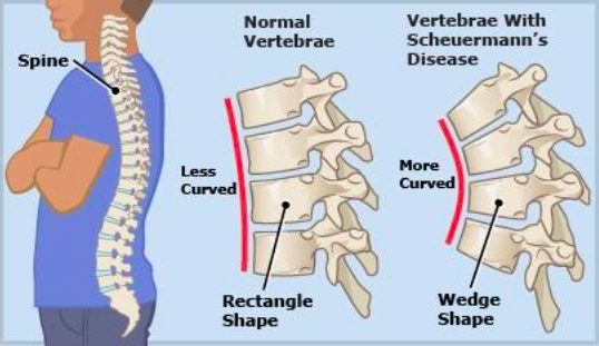 UNDERSANDING SCHEUERMANN'S DISEASE 1 Screen Shot 2024 06 17 at 12.32.03 pm