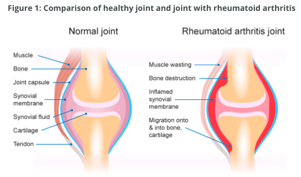 UNDERSTANDING RHEUMATOID ARTHRITIS: AN OSTEOPATH'S PERSPECTIVE 1 Screen Shot 2024 06 24 at 10.13.39 am