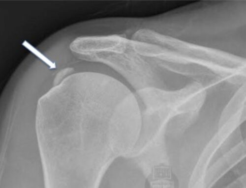 UNDERSTANDING CALCIFIC TENDINOPATHY AND OSTEOPATHY’S ROLE